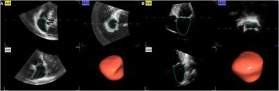 Exercise-Induced Atrial Remodeling in Female Amateur Marathon Runners Assessed by Three-Dimensional and Speckle Tracking Echocardiography